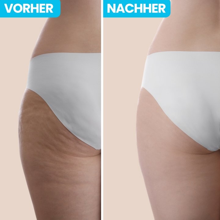 60% Rabatt | ProCellyred™️ 5-in-1 Anti-Cellulitis Infrarot-Massagegerät
