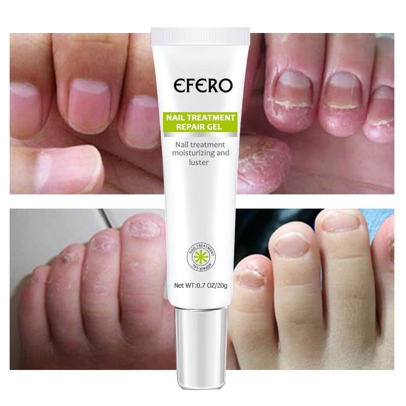 Nail Repair | Schnelle und effektive Ergebnisse! 1+1 GRATIS!