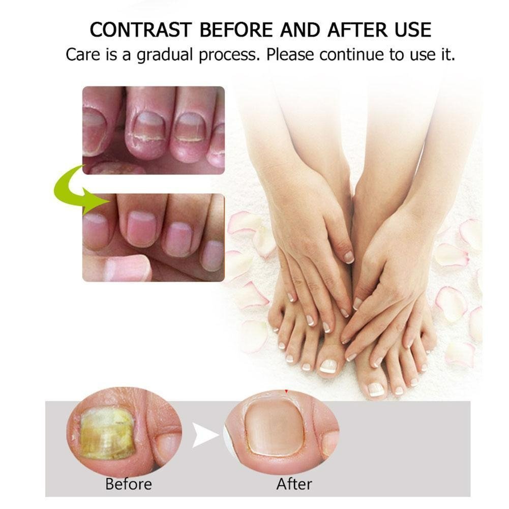 Nail Repair | Schnelle und effektive Ergebnisse! 1+1 GRATIS!